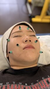 美容鍼灸の血流改善の施術イメージ