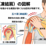 四十肩・五十肩による肩の痛みを腕の動かしさのイメージ