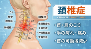 頸椎症による首の痛みや肩こり、手のしびれのイメージ